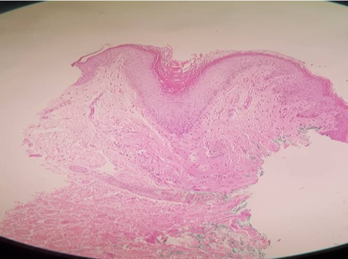 30 minutes post endopeel +PRP on large labia