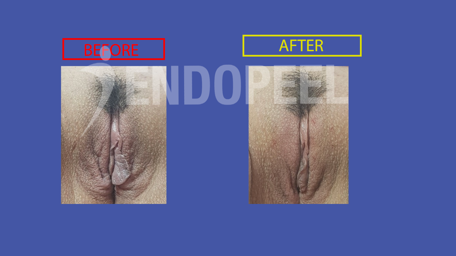 vulvar embellishment endopeel 4