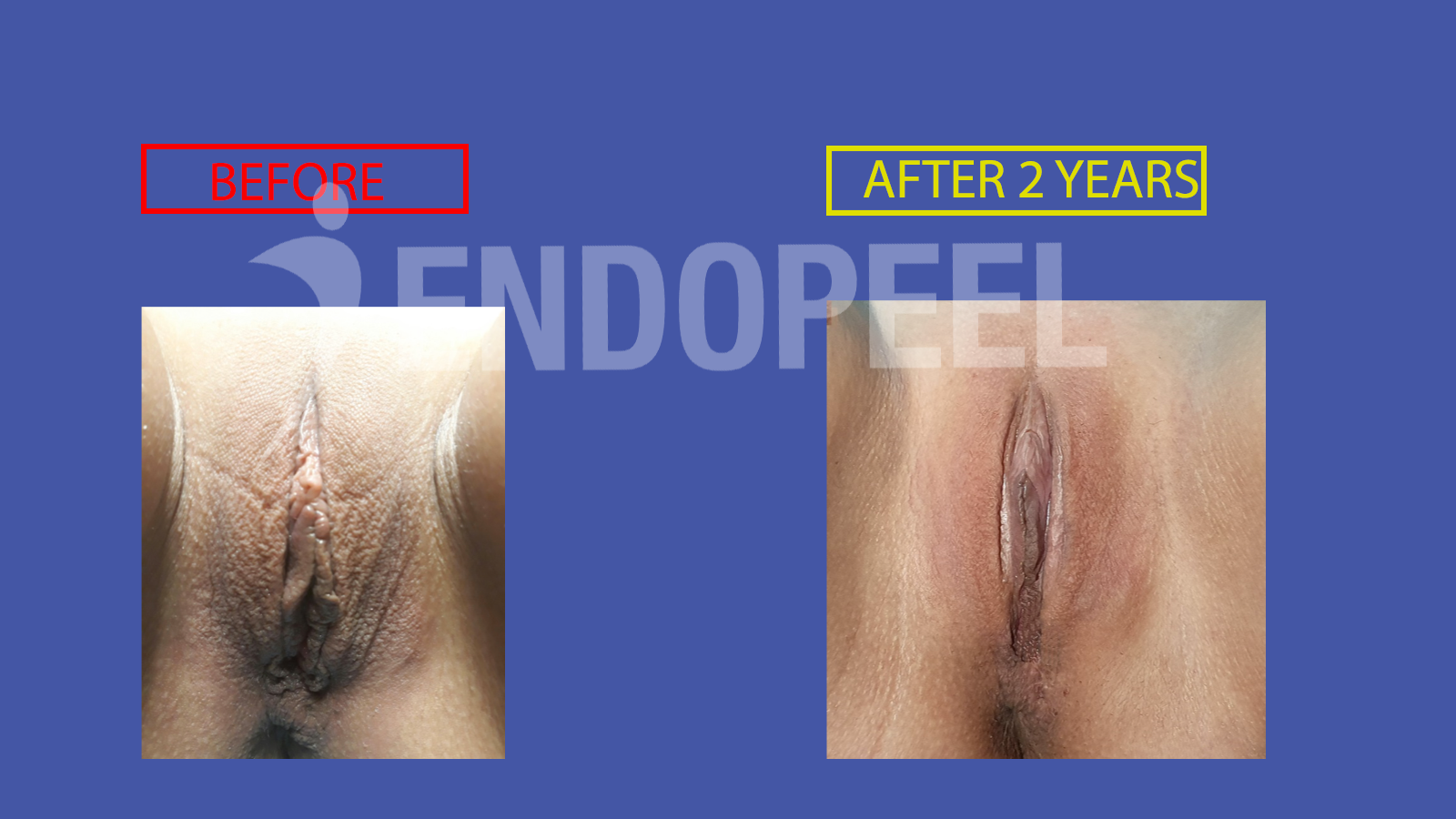 endopeel vulvar embellishment 14