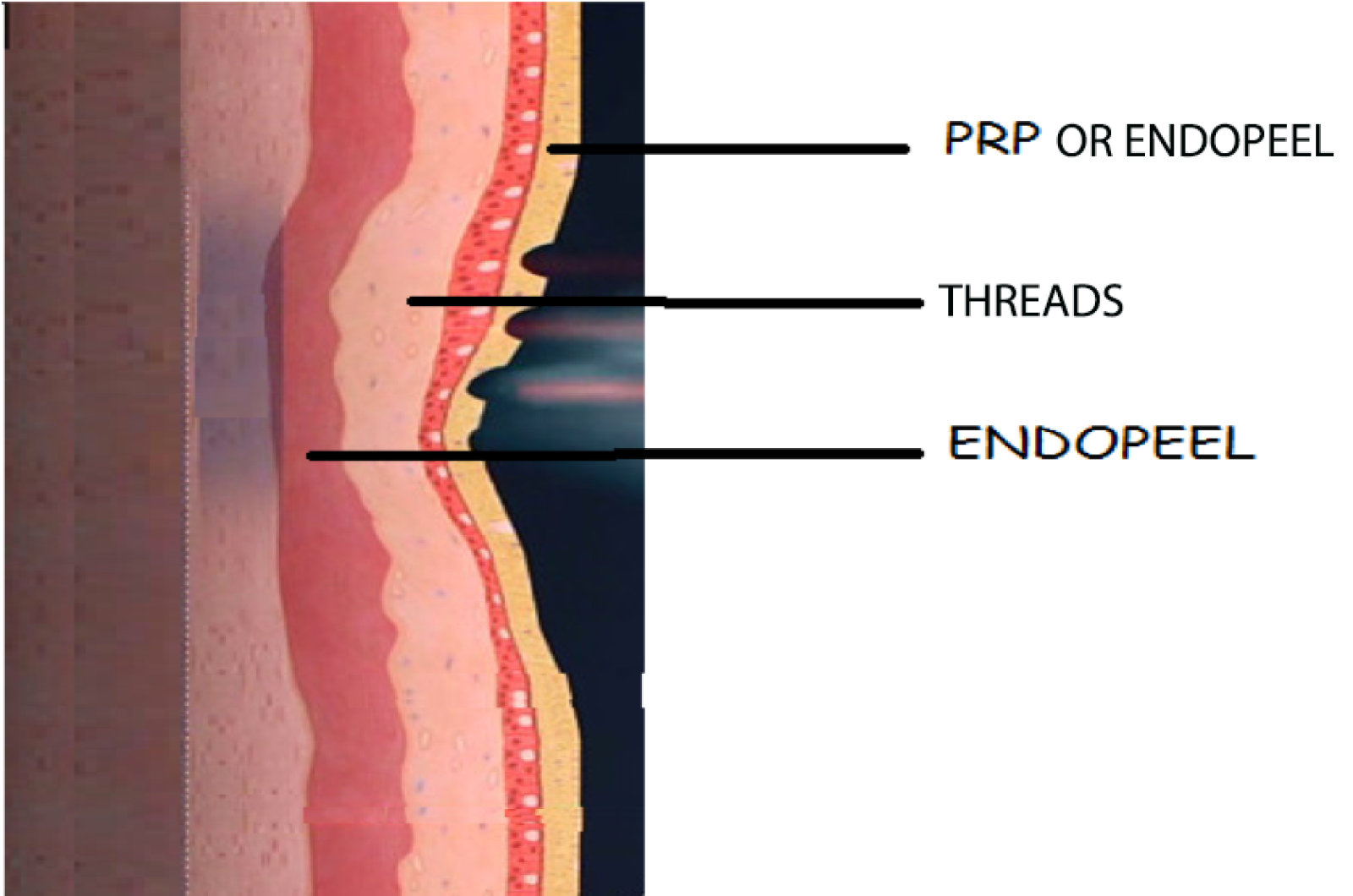 lateral face of the vagina