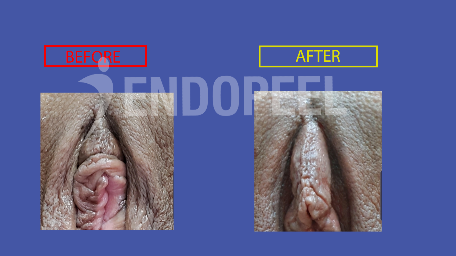 endopeel vulvar embellishment 15