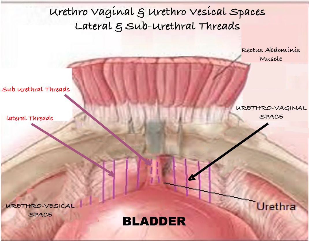 urinary-incontinence-threads