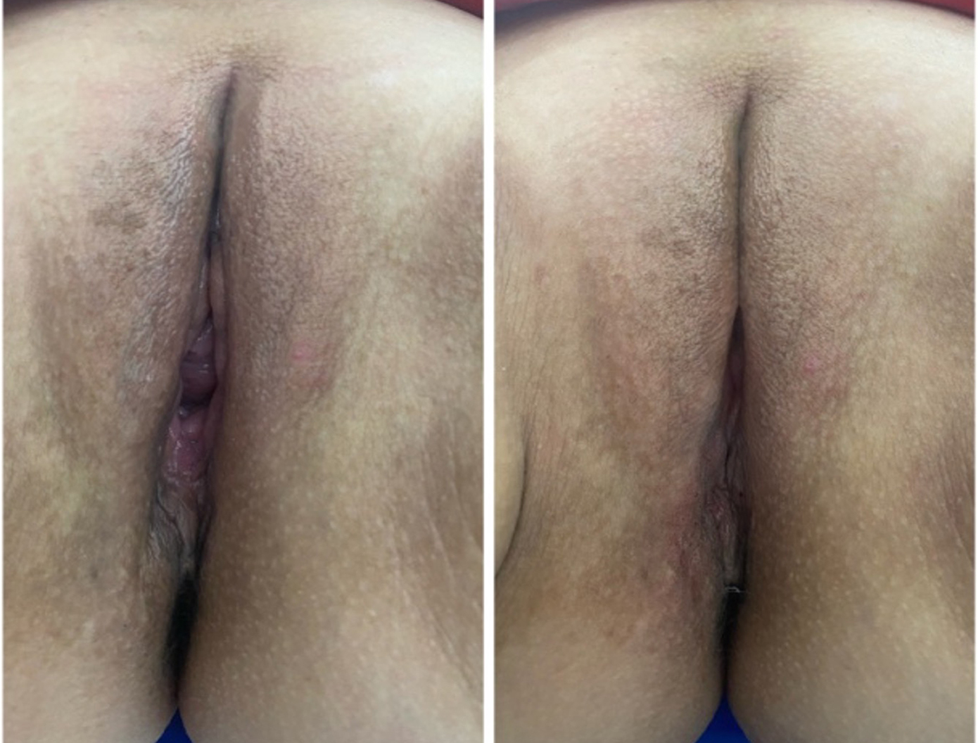 scar-remodeling-episiotomy2