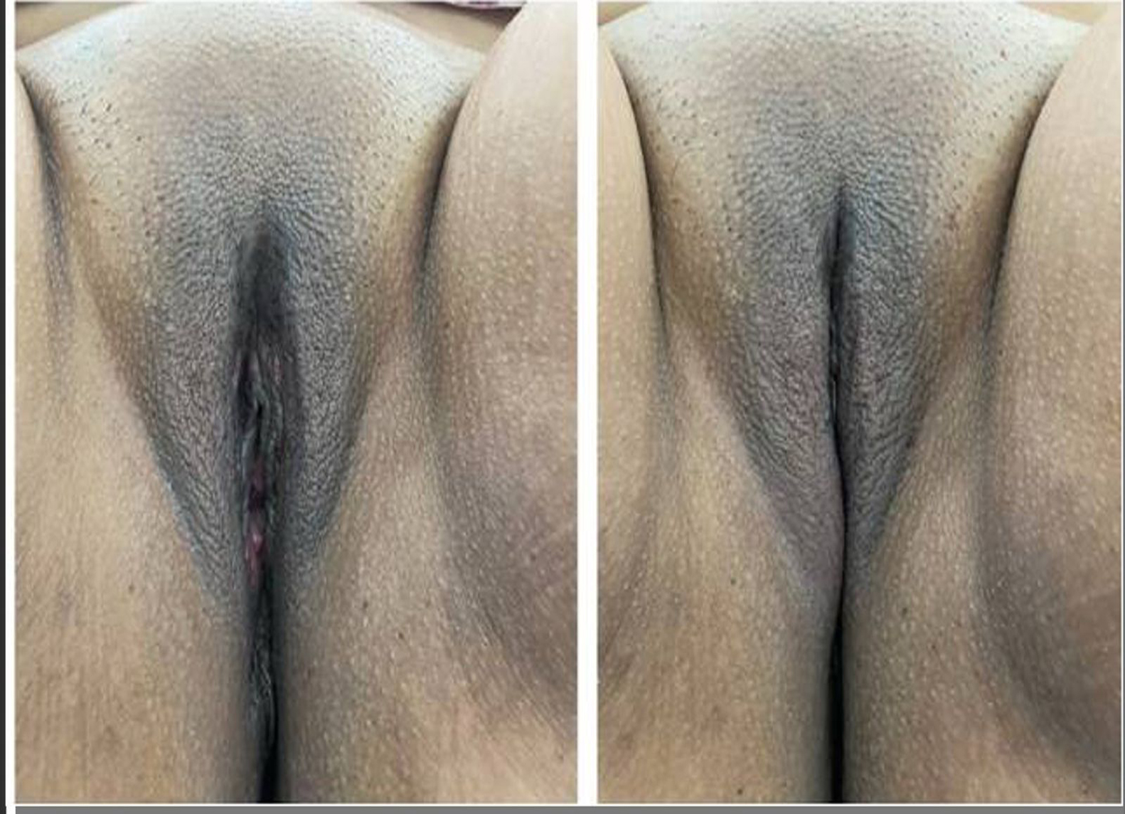 shortening-major-lips3