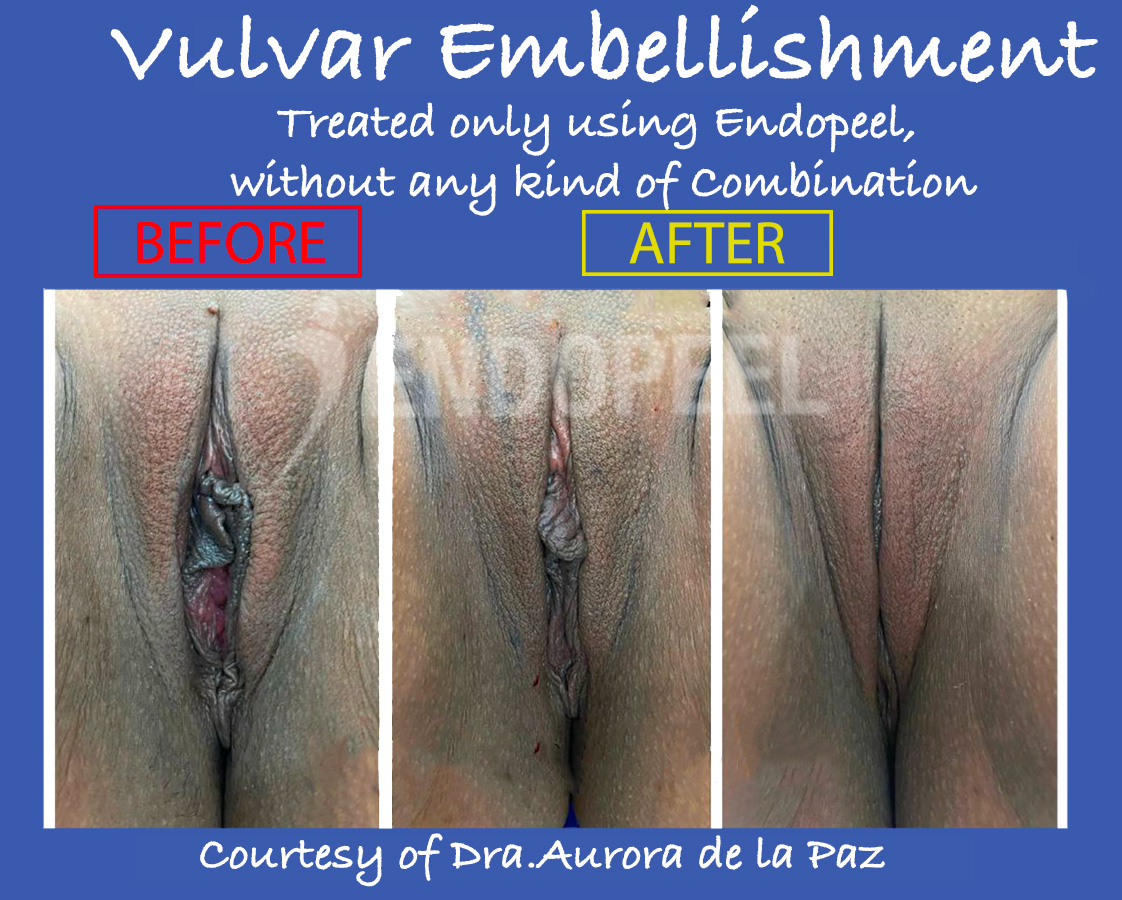 vulvar-embellishment-no-combination-aurora.jpg
