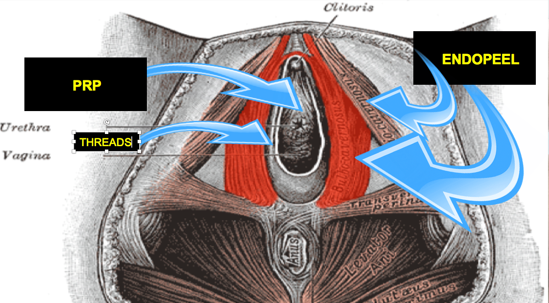 Vaginal Walls Tensioning