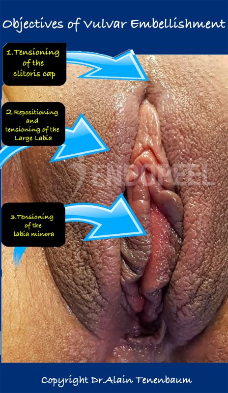 vulvar-embellishment/vulvar-embellishment-objectives.jpg