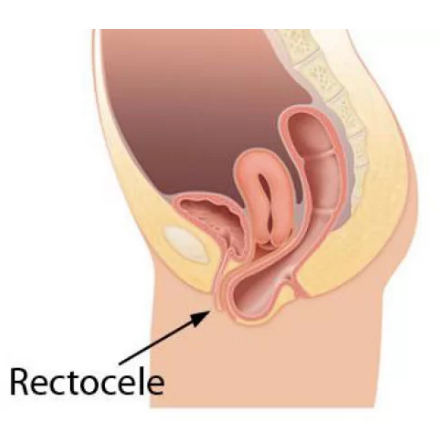 rectocele