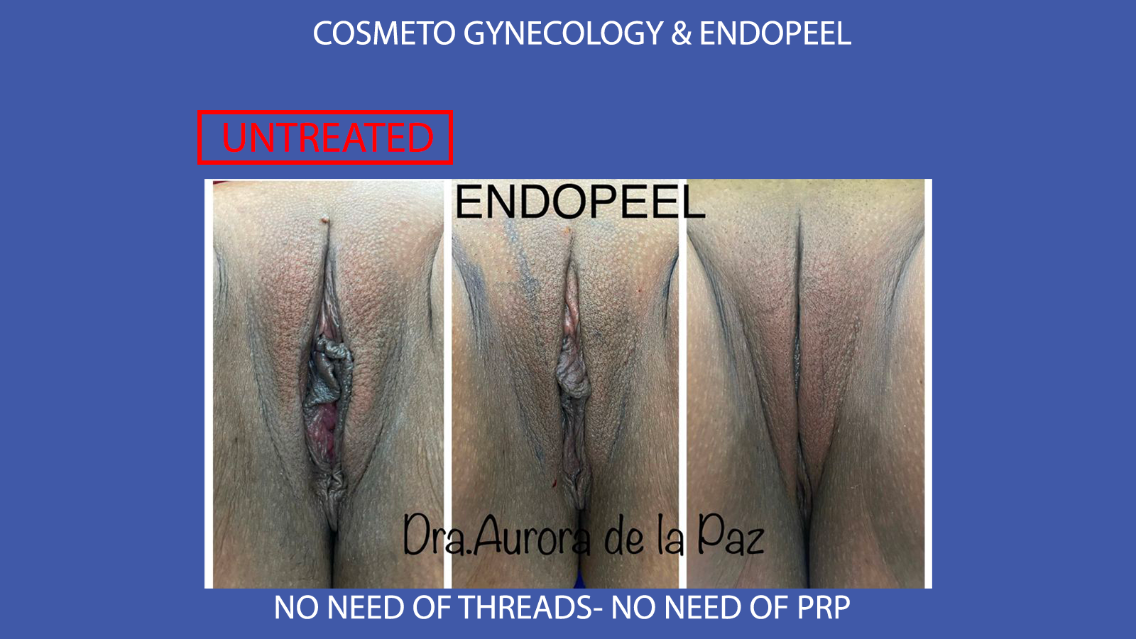 cosmeto gynecology by Dra.Aurora de la Paz