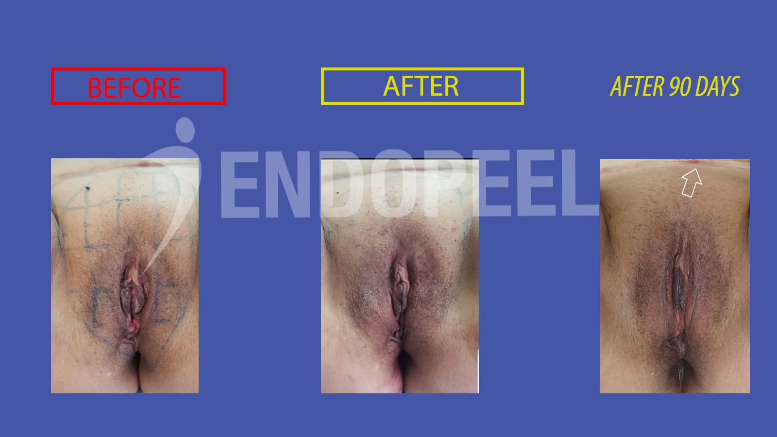 vulvar embellishment endopeel 7