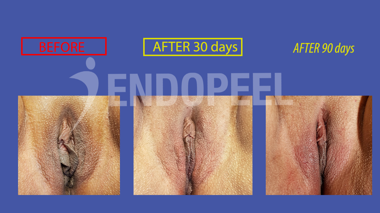 endopeel vulvar embellishment 12