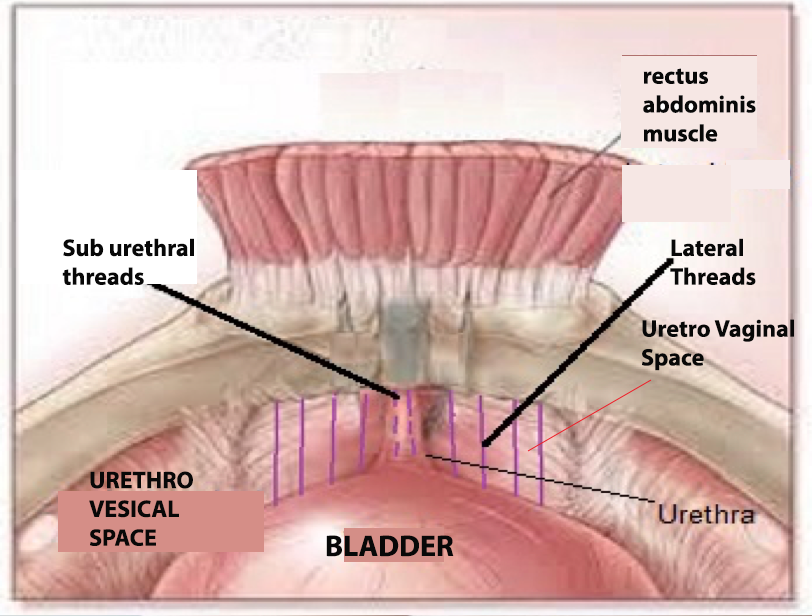 urethro vesical vaginal space