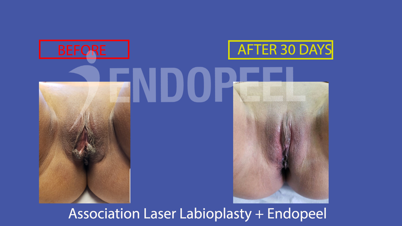 laserlabioplasty-endopeel