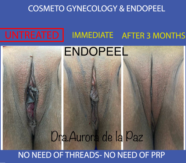 cosmeto gynecology and endopeel used without combined technics