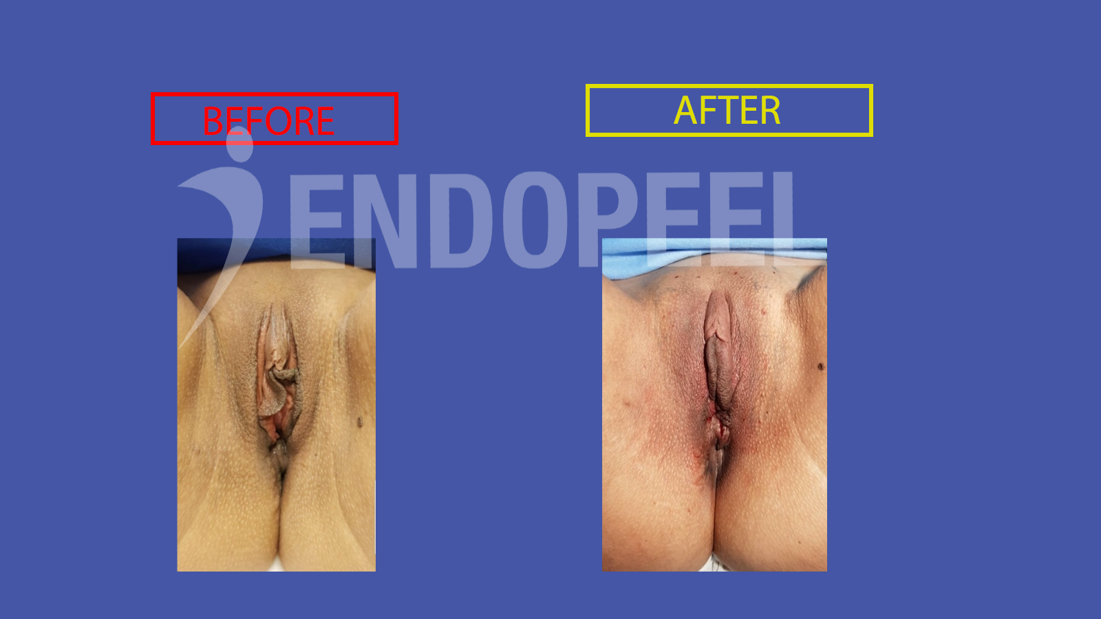 vulvar embellishment endopeel 6
