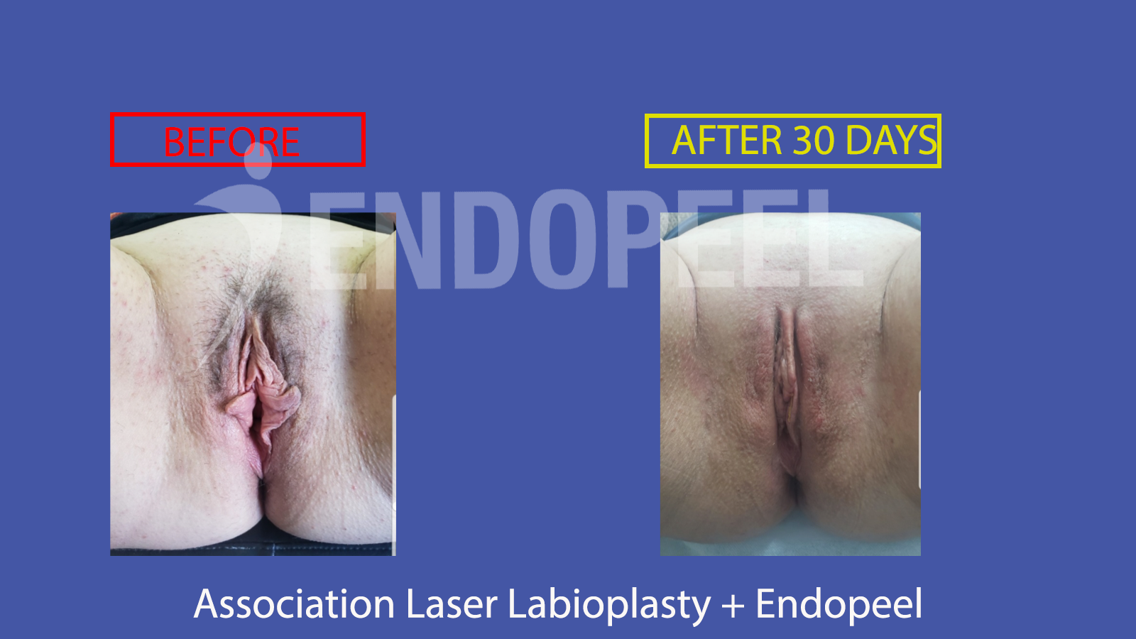laserlabioplasty-endopeel2