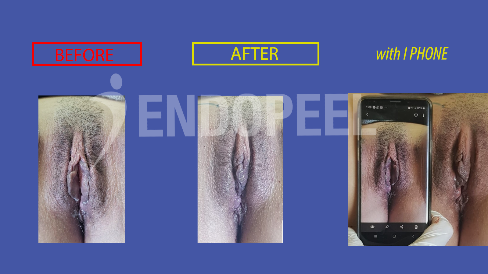 vulvar embellishment endopeel 9